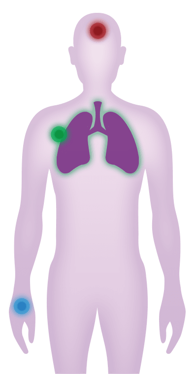Discover the symptoms and impact of pneumococcal pneumonia on your chest