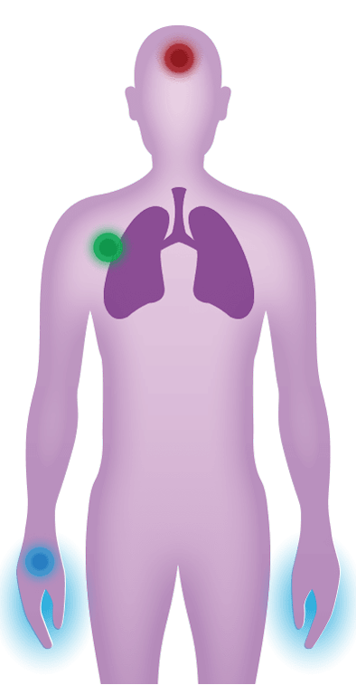 Learn about the symptoms and impact of pneumococcal pneumonia on your nails.